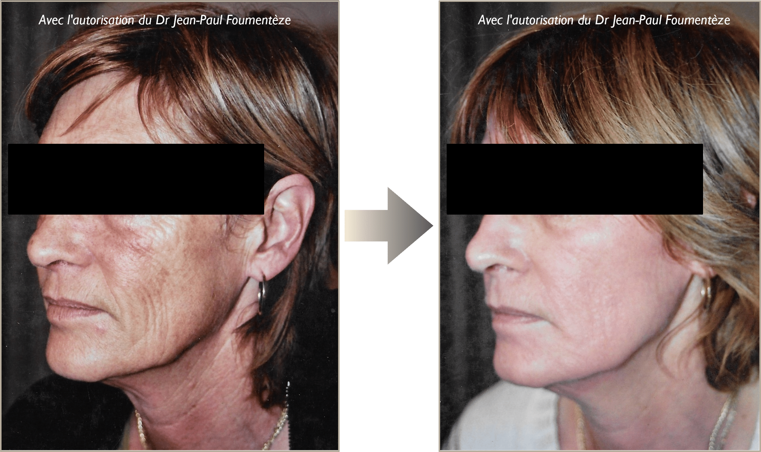 Avant-apres peeling phenol nice