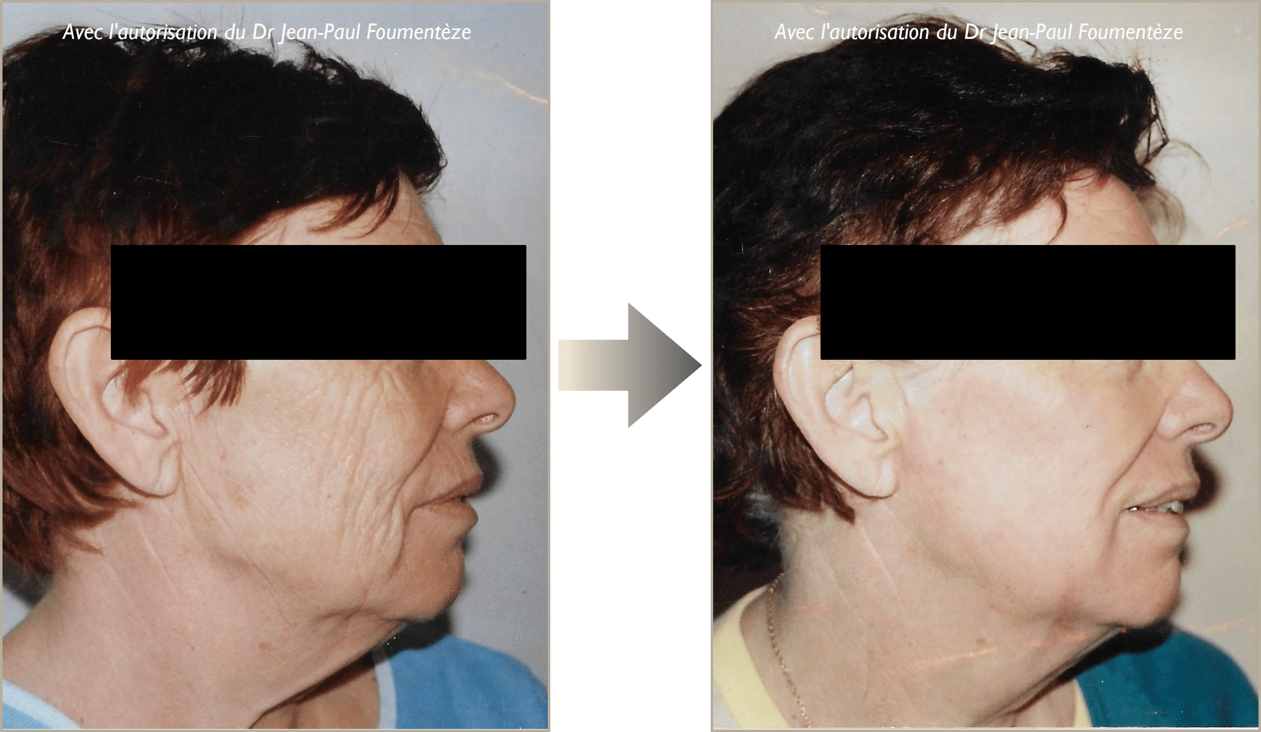 peeling avant-apres nice
