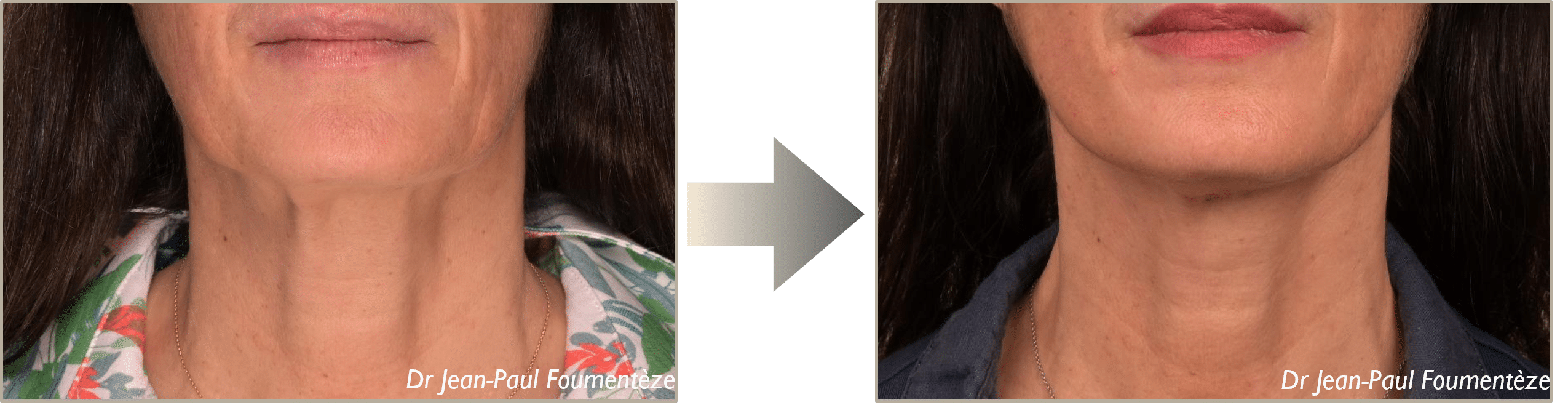 Dr. Foumenteze - Résultat de pose de fils tenseurs sur angle cervico-mentonnier & cordes platysmales – Vue de face