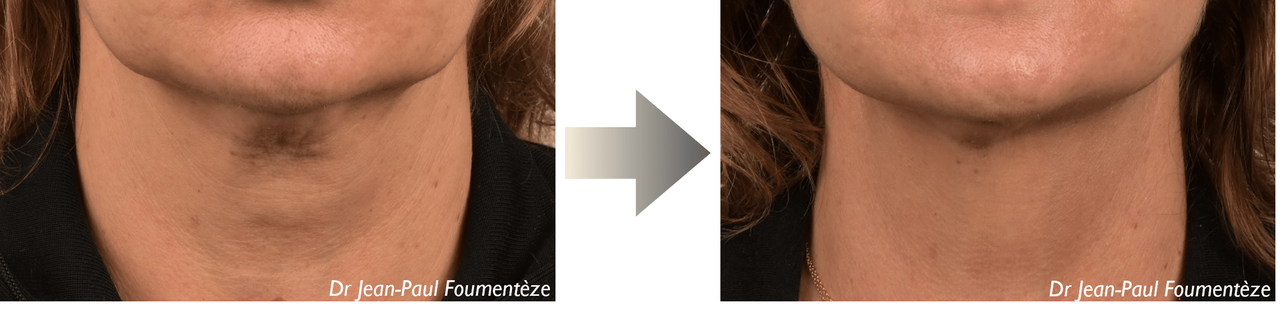 Dr. Foumenteze - Résultat de pose de fils tenseurs sur angle cervico-mentonnier & cordes platysmales – Vue de face