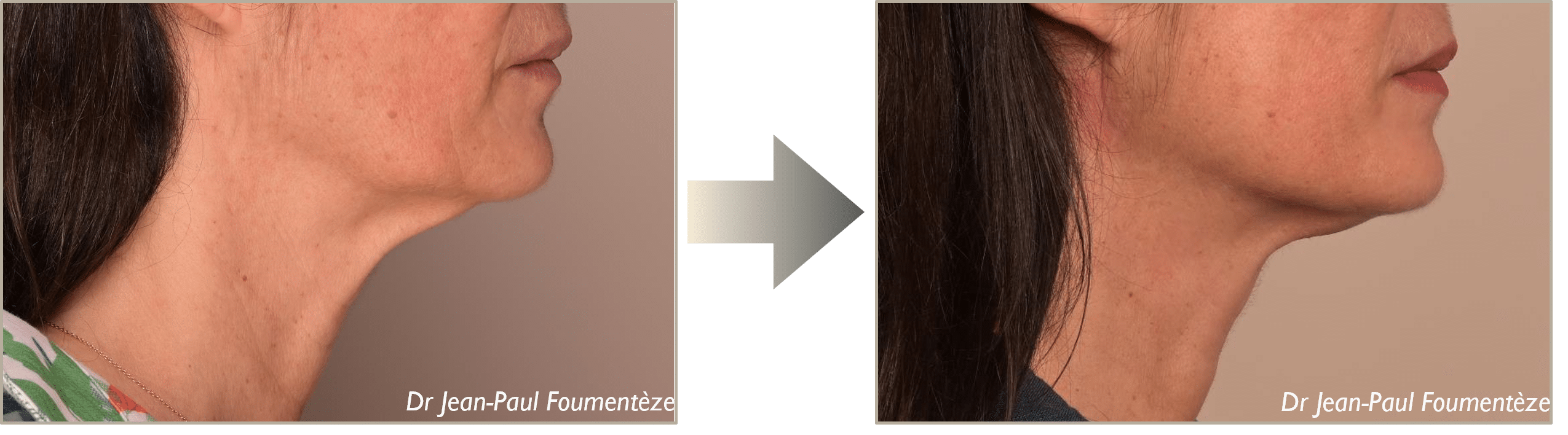 Dr. Foumenteze - Résultat de pose de fils tenseurs sur angle cervico-mentonnier & cordes platysmales – Vue de profil droit