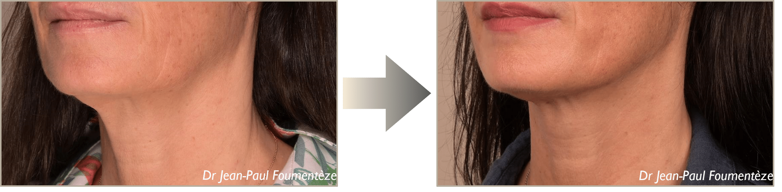 Dr. Foumenteze - Résultat de pose de fils tenseurs sur angle cervico-mentonnier & cordes platysmales – Vue de 3/4