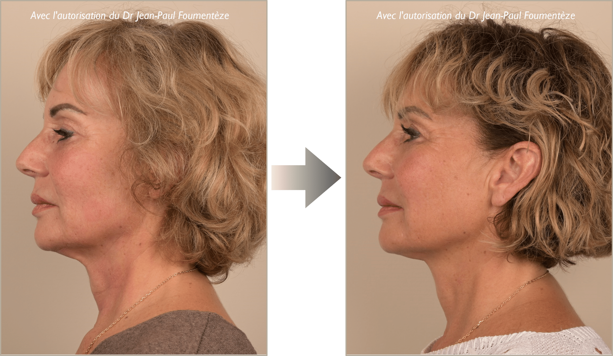 Dr. Foumenteze - Résultat de pose de fils tenseurs sur angle cervico-mentonnier & cordes platysmales – Vue de profil gauche