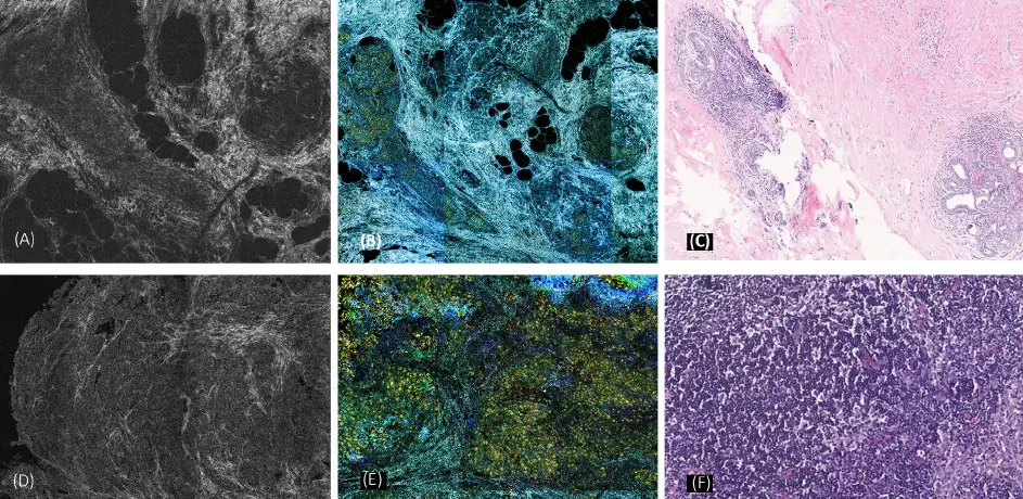 FF-OCT: Quick On-Site Polyp Evaluation in Colonoscopy