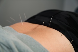Integrative Dry Needling