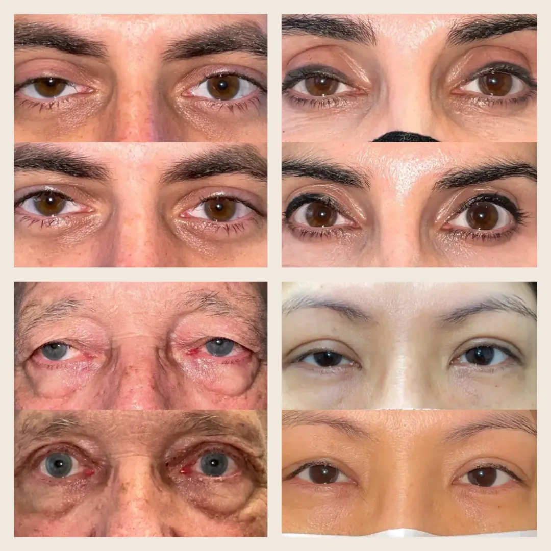 Six before-and-after photos showing upper face close-ups of eyes with improved appearance, reduced puffiness, and more alert look.