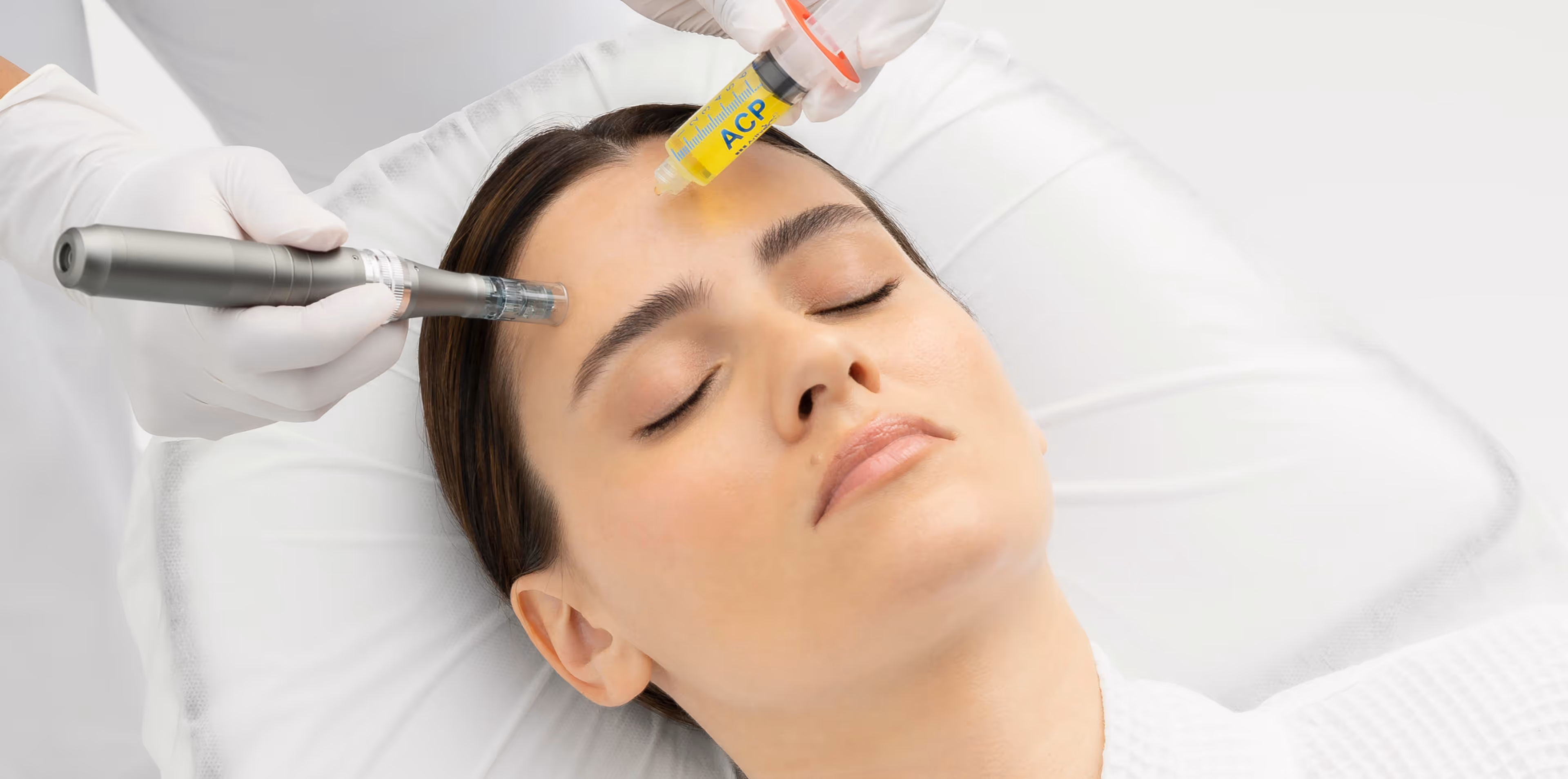 Person lying on a treatment bed while a gloved professional applies a device to the forehead and holds a syringe labeled ACP for wrinkle treatment with PRP.