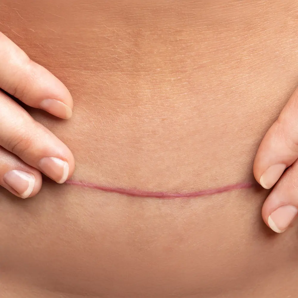 Narben können den Bewegungsfluss stören. Mit spezifischen Techniken wird das Gewebe gelöst, die Durchblutung verbessert und Beschwerden wie Spannungsgefühl deutlich reduziert.