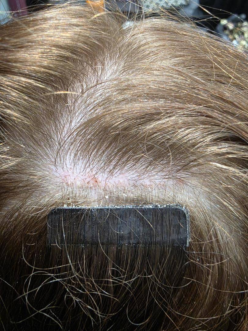 Löshår som är fel insatt av ej utbildade sensory frisörer