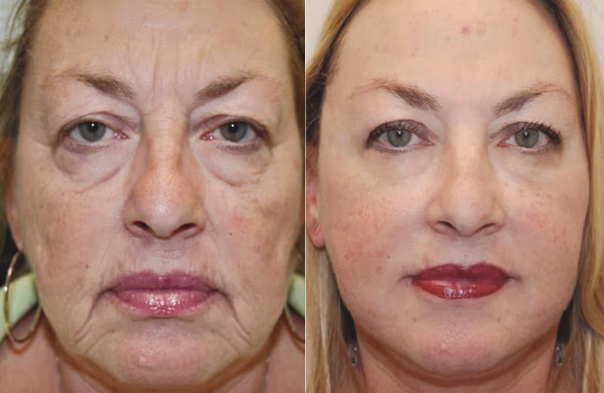 Result study 01, Bellagio Medical Spa before-and-after example