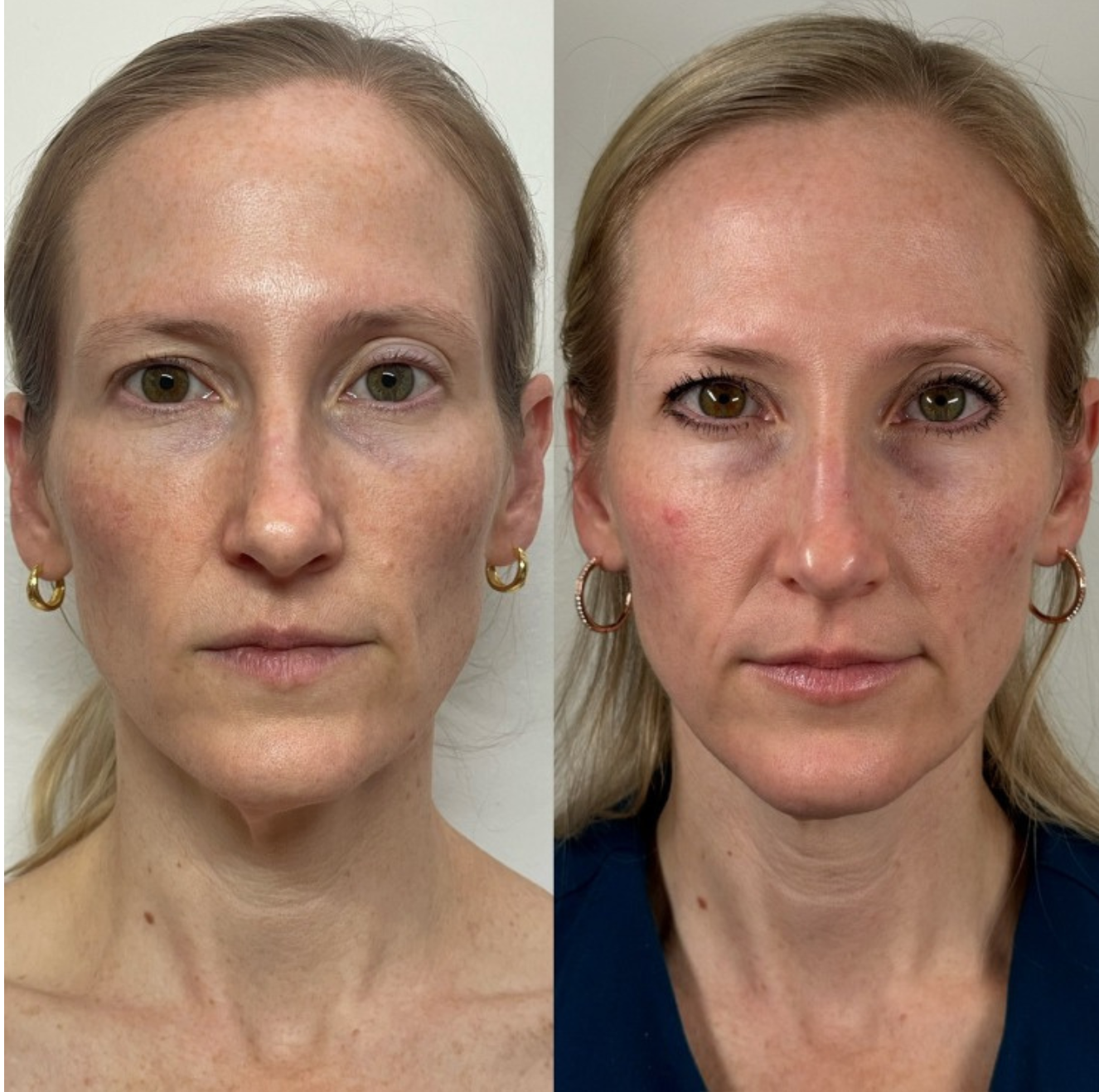Microneedling before and after - client result 3