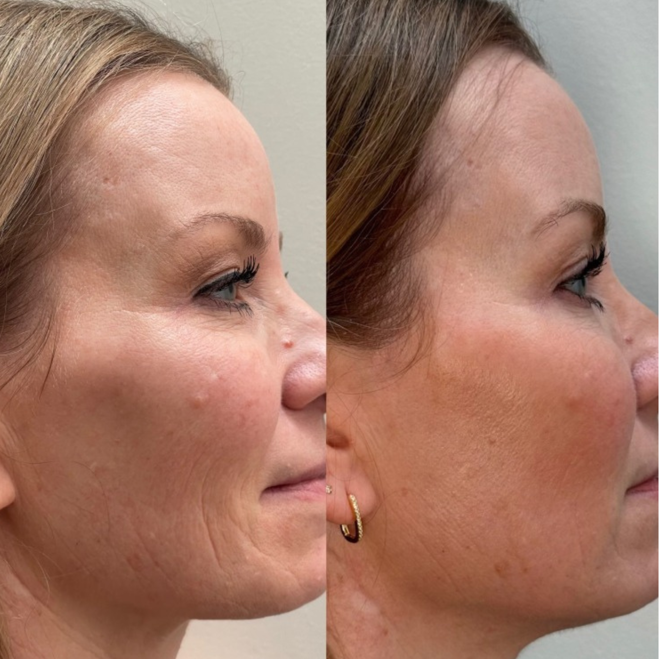 Microneedling before and after - client result 1