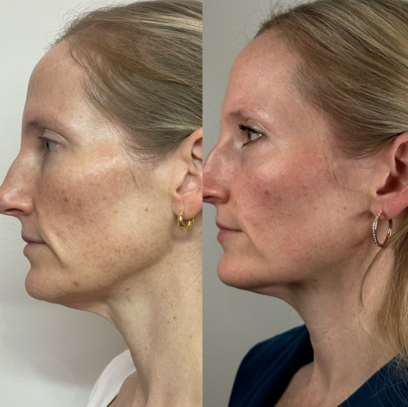 Microneedling before and after - client result 4