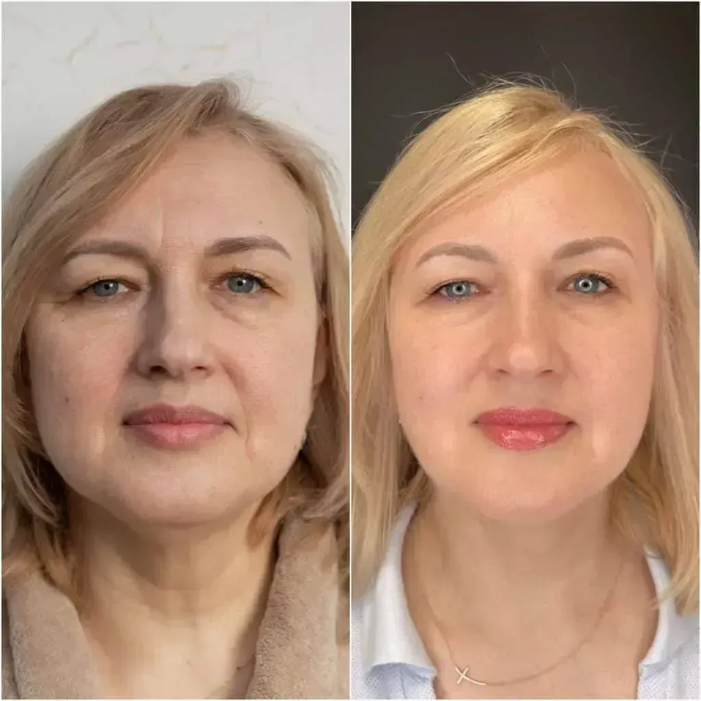 Complete before and after treatment comparison supplied by Bellagio Medical Spa