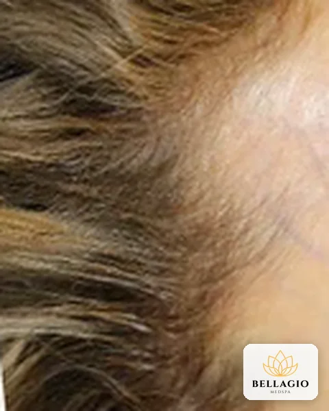 Hairline after PRP: fuller density