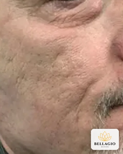 Cheek before PRP: rough texture, visible pores