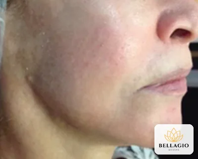 Jawline after PRP: smoother, even skin