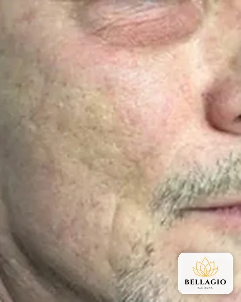 Cheek after PRP: smoother texture