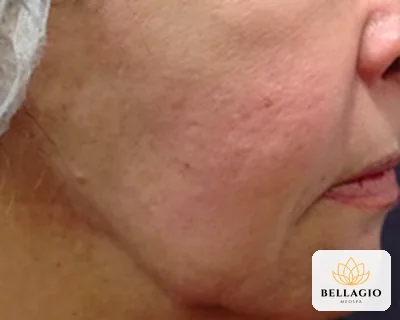 Jawline before PRP: uneven tone