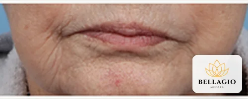 Mouth area before PRP: fine lines