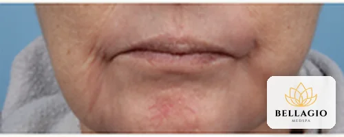 Mouth area after PRP: softer lines