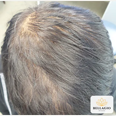 Scalp before PRP: thinning hair
