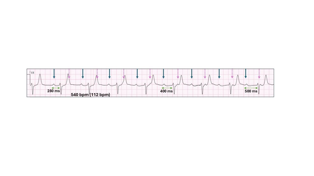 A graph of a heart rateAI-generated content may be incorrect.