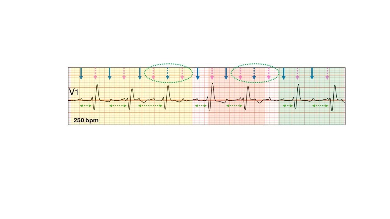 A graph of a heart rateAI-generated content may be incorrect.