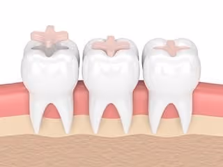 dental inlay