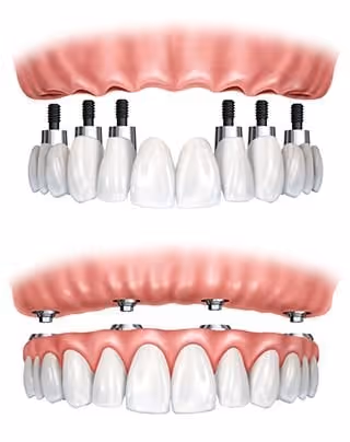 implant denture