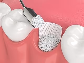 bone graft