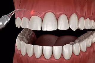 cosmetic gum surgery