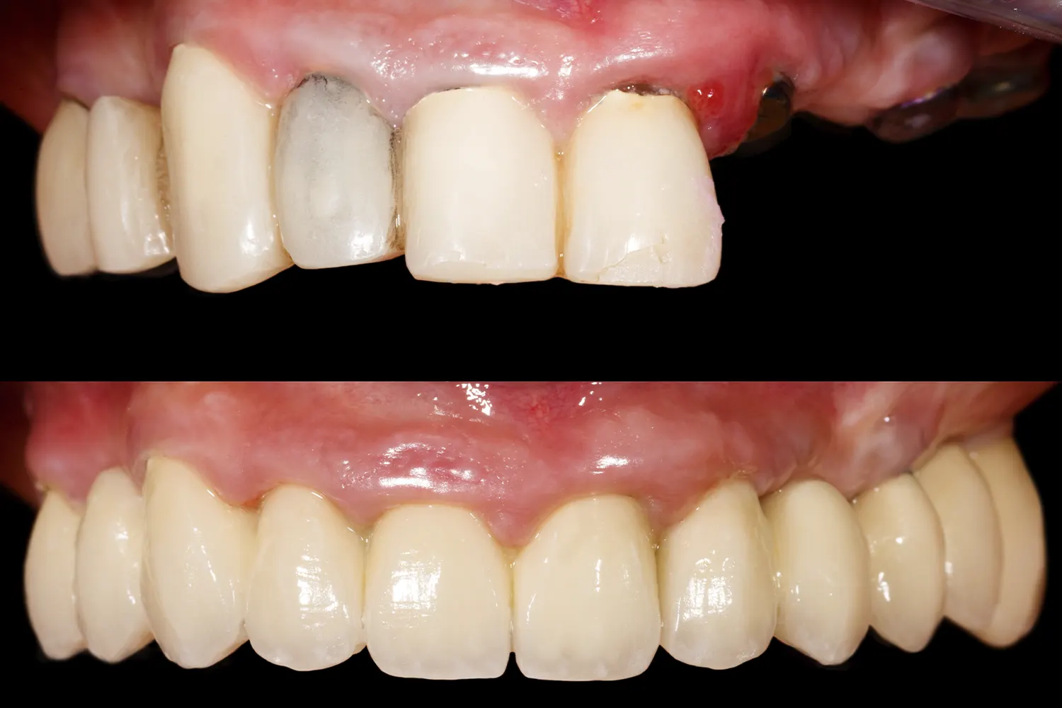 Full-Mouth Reconstruction Treatment Planning: Why Every Discipline Belongs at the Table
