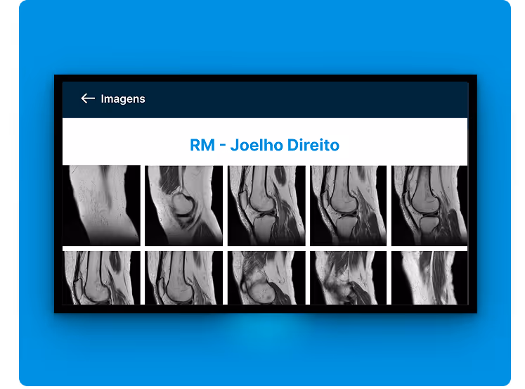 Imágenes de resonancia magnética de la rodilla derecha que muestran varias secciones en tonos de gris.