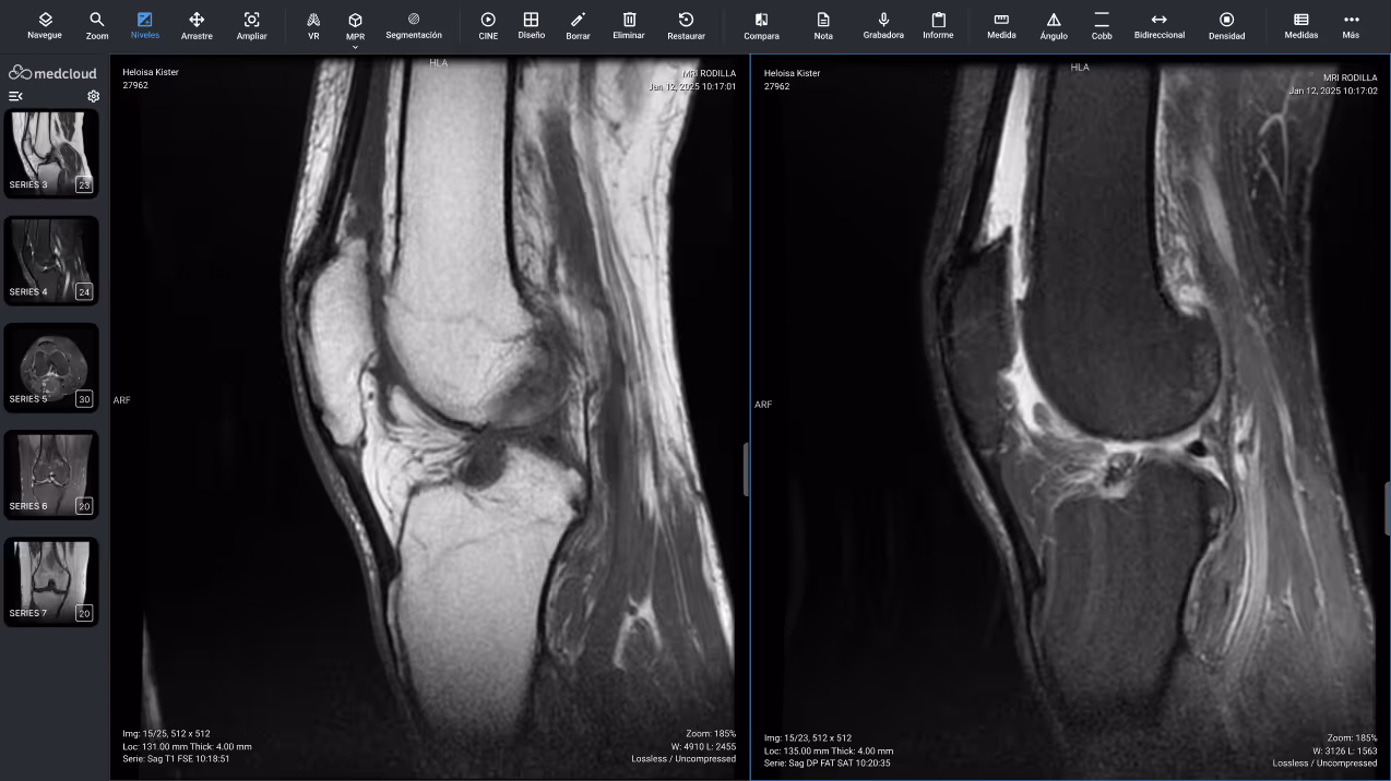 Pantalla de visualización de resonancia magnética que muestra imágenes sagitales de la rodilla de un paciente con los niveles de tejido y estructuras óseas.