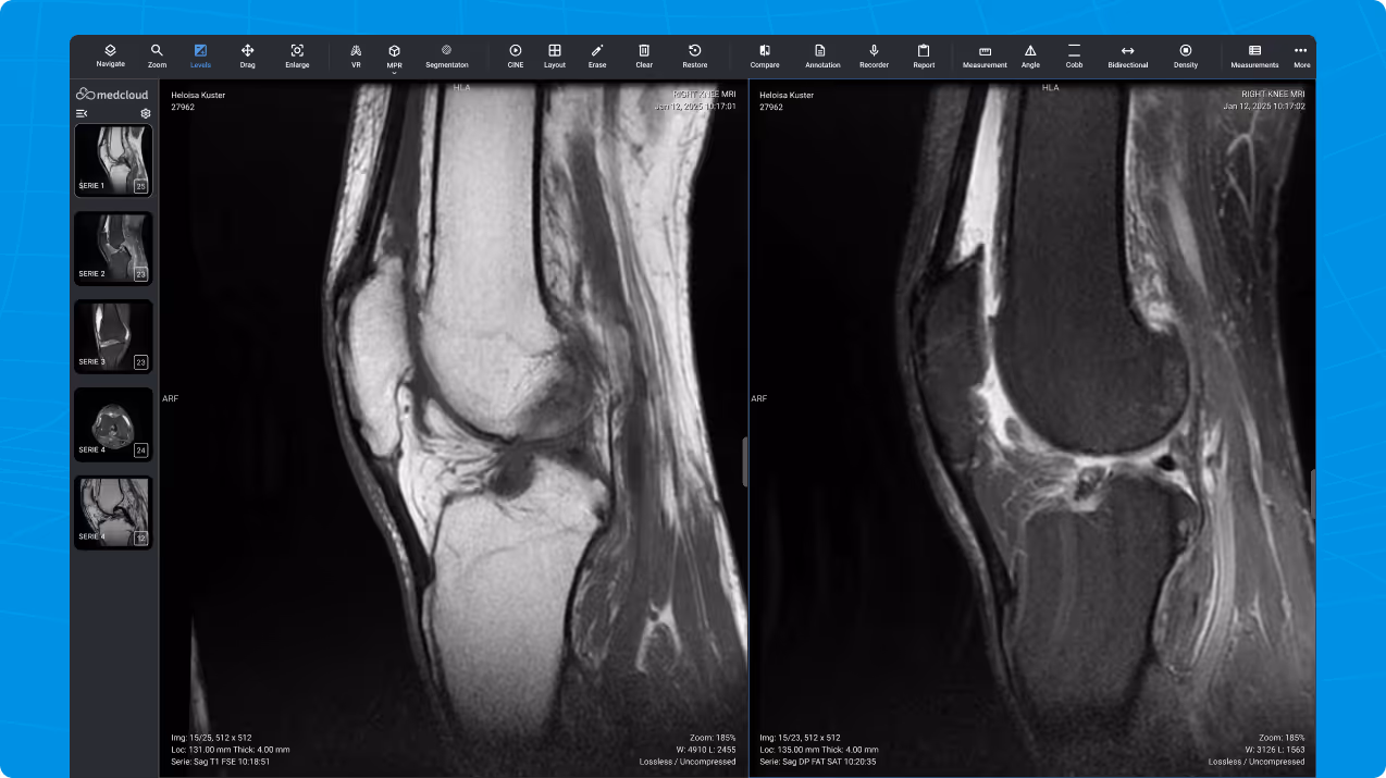 Right knee MRI images showing sagittal cuts in different contrast modes.