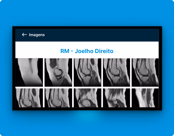 Imagens de ressonância magnética do joelho direito mostrando diferentes cortes e ângulos da articulação.
