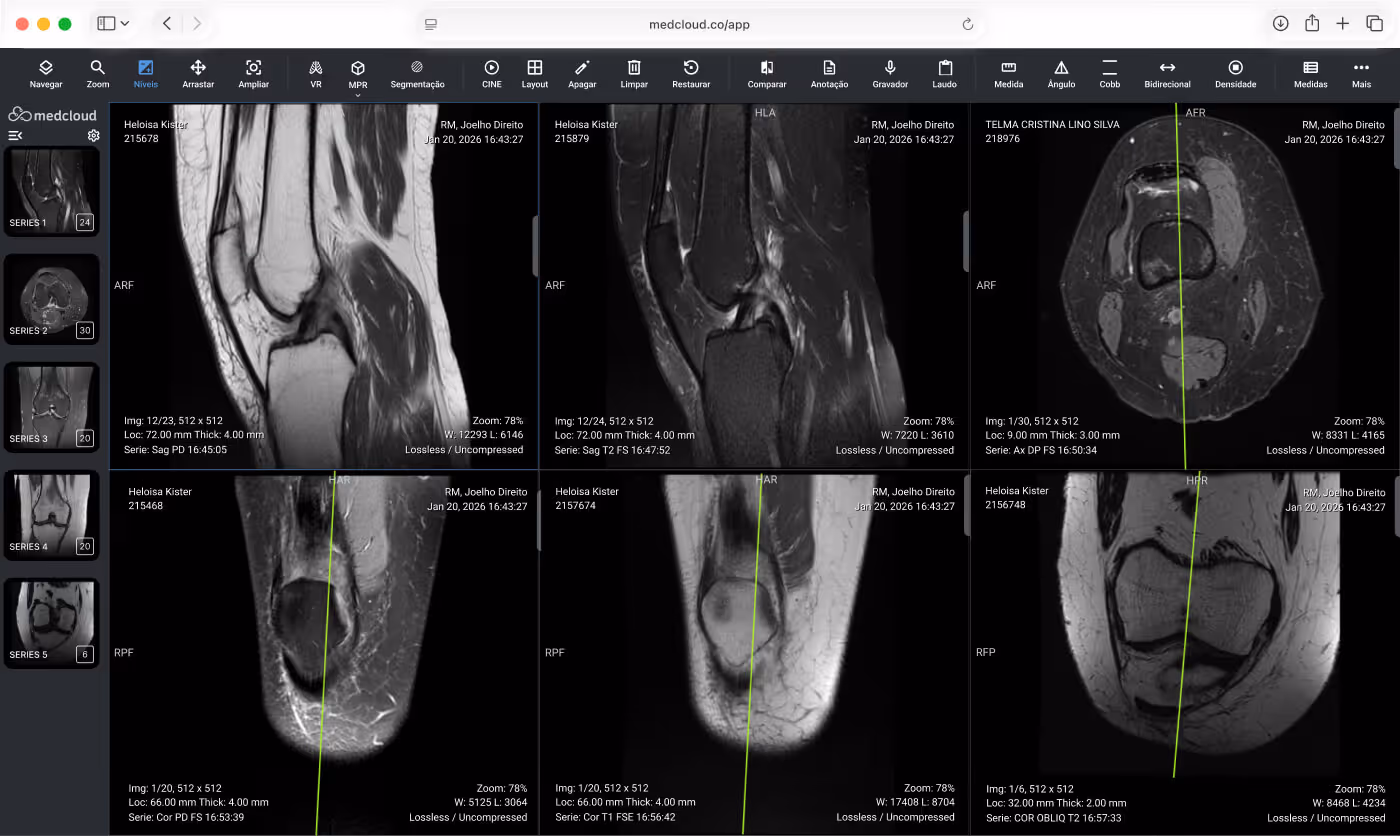 Tela do software Medcloud mostrando múltiplas imagens de ressonância magnética do joelho direito em diferentes cortes e modos.