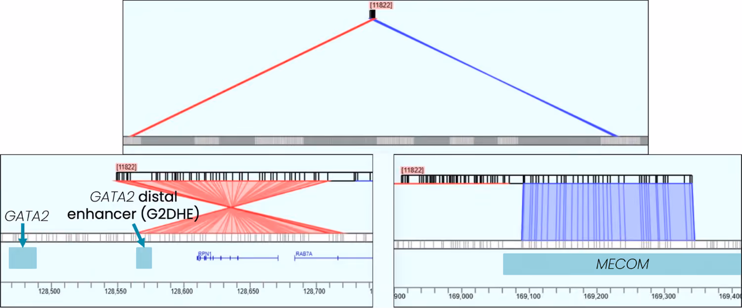 Figure 3. inv(3)(q21q26) inversion in the MOLM-1 cell line visualized in HCE. (Top) Overview of contig spanning chromosome 3, with a V-shaped arc indicating a large rearrangement. (Bottom left) Zoomed view of the left breakpoint at the GATA2 enhancer region; fanning red lines indicate the inverted contig alignment. (Bottom right) Zoomed view of the right breakpoint at the MECOM locus showing concordant forward contig alignment in blue. The rearrangement is consistent with a paracentric inversion involving MECOM and the GATA2 enhancer, with little to no accompanying copy number change.