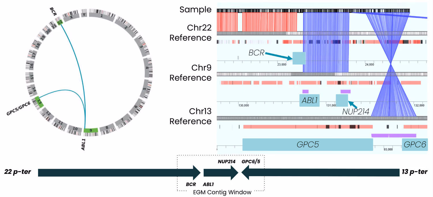 Figure 5. Complex BCR::ABL1 rearrangement in the K562 CML cell line visualized in HCE. (Left) Circos plot illustrating interchromosomal connections among chromosomes 9, 13, and 22. (Right) A single EGM contig maps sequentially through chr22 (BCR), chr9 (ABL1), and chr13 (NUP214, GPC6/5); contig alignments and reference intervals for each chromosome are shown. (Bottom) The EGM contig window displays the reconstructed gene order across the three-chromosome rearrangement, from 22 p-ter through 13 p-ter.1
