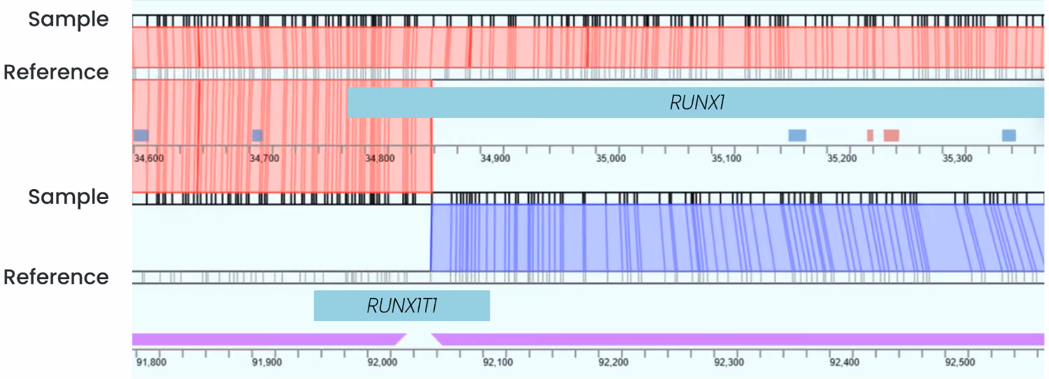 Figure 4. RUNX1::RUNX1T1 fusion in an AML cell line (Kasumi-1) visualized in HCE. The top track (Allele 1) maps to chromosome 21 and represents the unaffected homolog, showing no structural variation. The bottom track (Allele 2) maps to both chr21 and chr8, indicating a translocation in which RUNX1 is fused to RUNX1T1. Genes are represented as teal and green rectangles; translocations are represented as purple trapezoids.