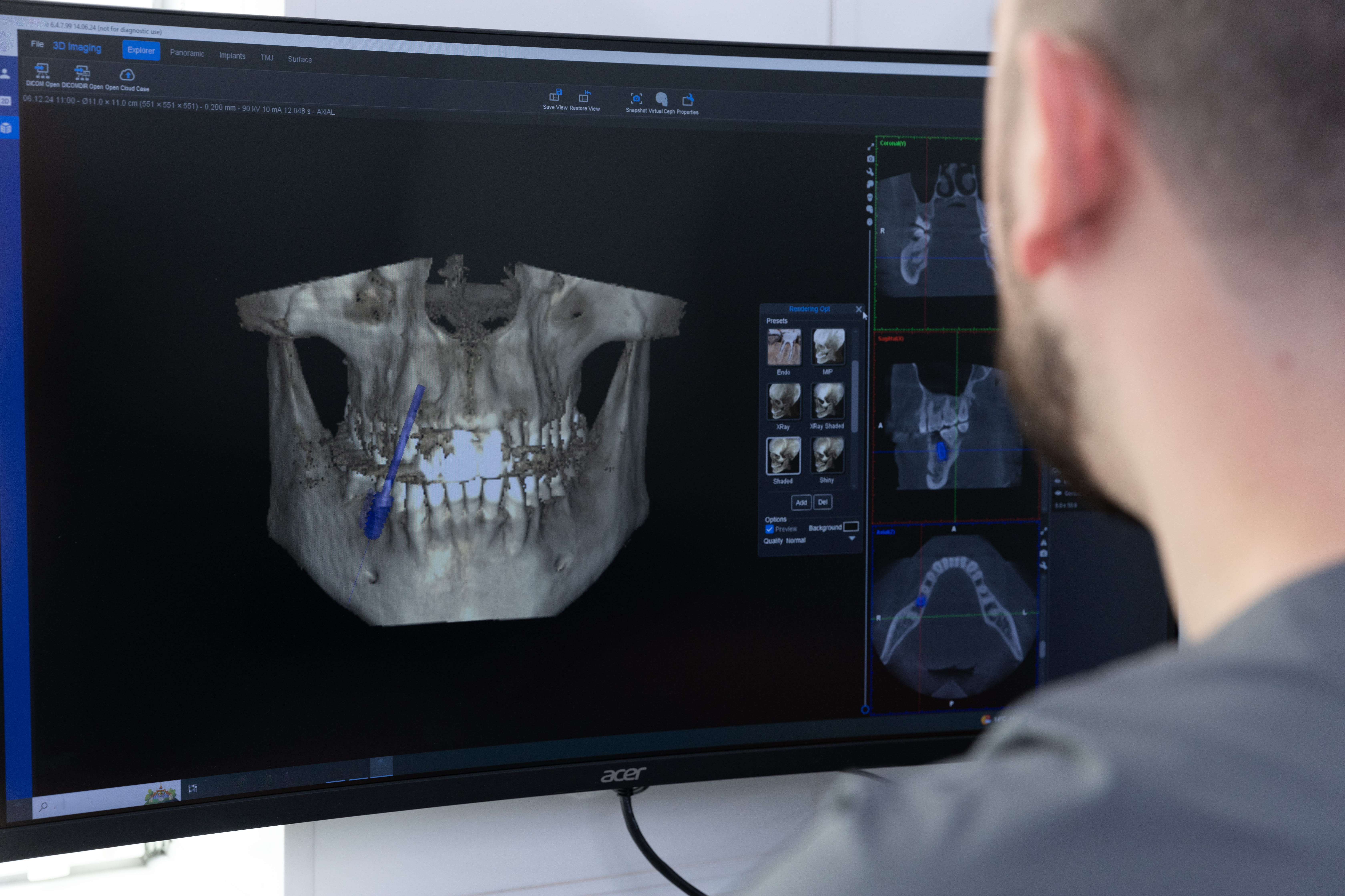 Precision Restorative Care: How 3D Imaging Changes Dental Implants for Medina Patients