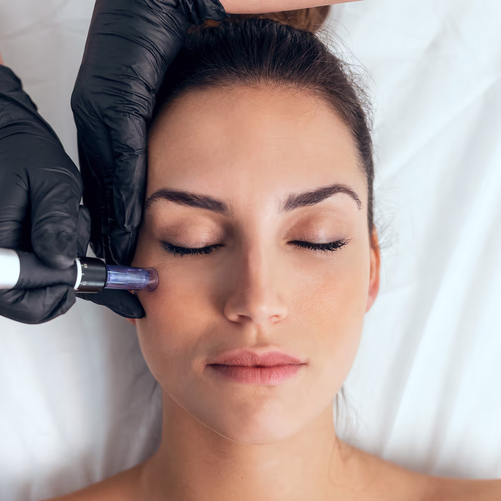 Kybella