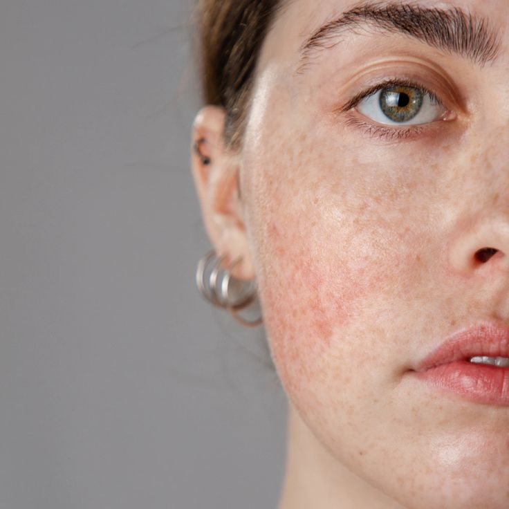 Laser Red Vein Removal