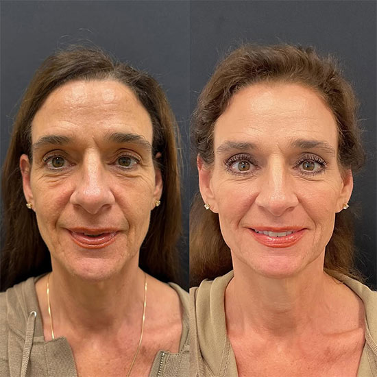 Before & After Image