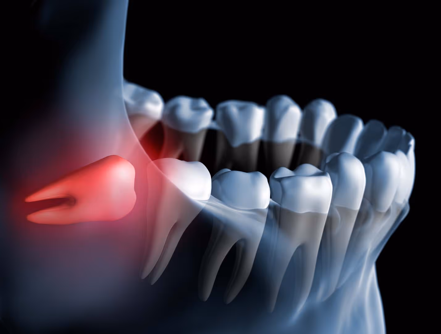 Now Is a Good Time for a Wisdom Tooth Removal Evaluation