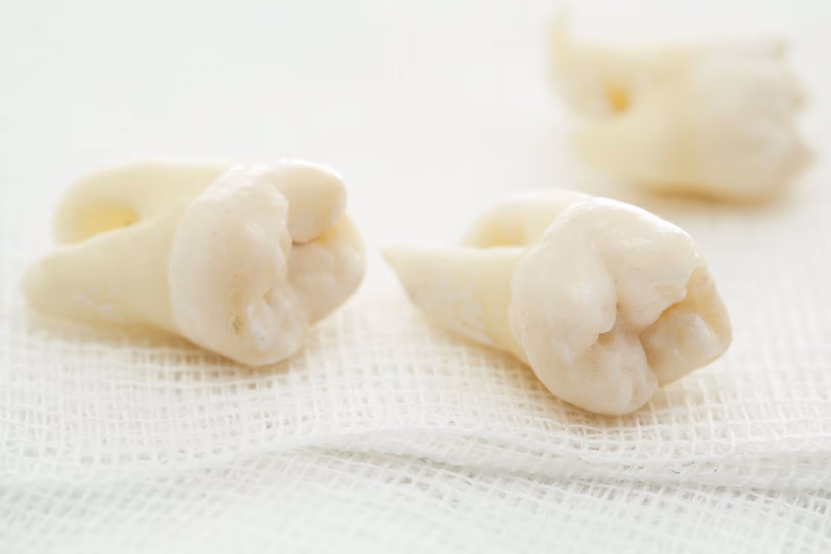 Summer Is a Good Time for Wisdom Tooth Removal