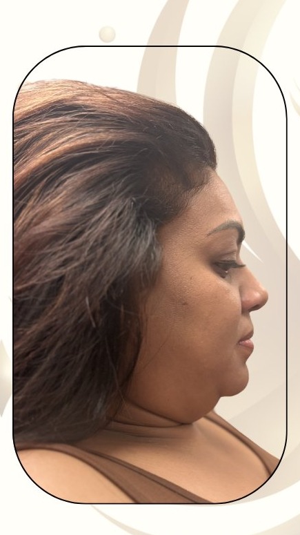 Before — Alma Accent Prime Sculpt and Refine Facial
