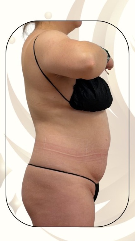 Before — Accent Prime Mommy Makeover