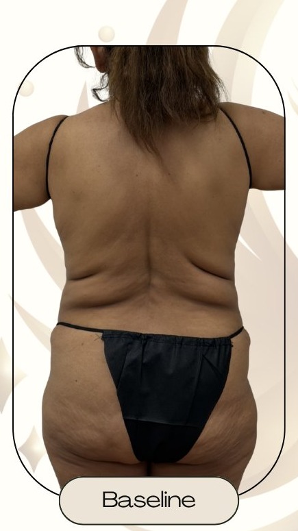 Before — Accent Prime US/RF Lower Back